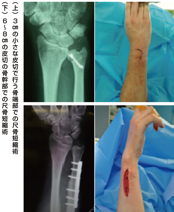 （上）3㎝の小さな皮切で行う骨端部での尺骨短縮術 （下）6〜8㎝の皮切の骨幹部での尺骨短縮術