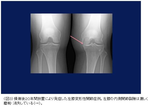 膝の靱帯手術を受けられる患者様へ｜スポーツ整形外科 - 診療科目一覧 