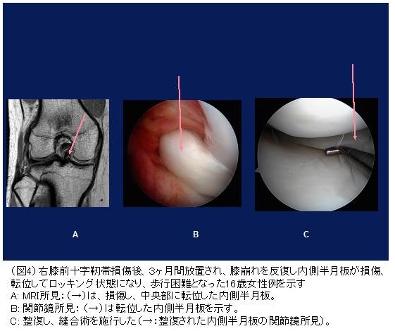 膝の靱帯手術を受けられる患者様へ｜スポーツ整形外科 - 診療科目一覧