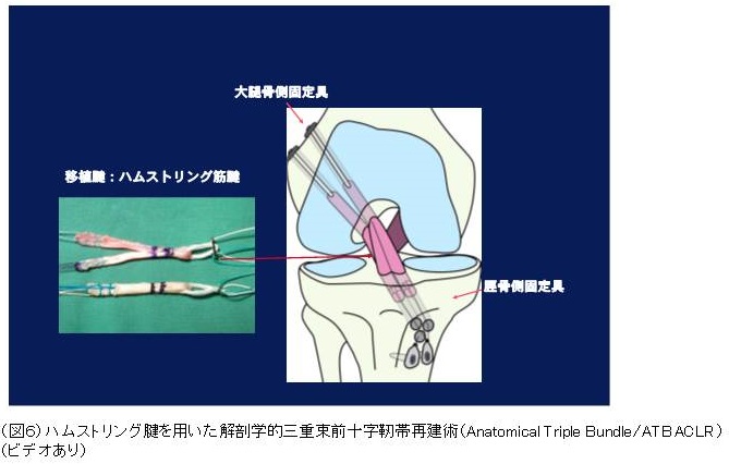膝の靱帯手術を受けられる患者様へ｜スポーツ整形外科 - 診療科目一覧 