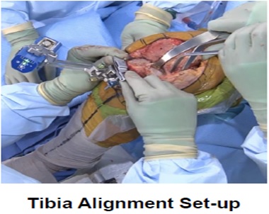 Tibia Alignment Set-up